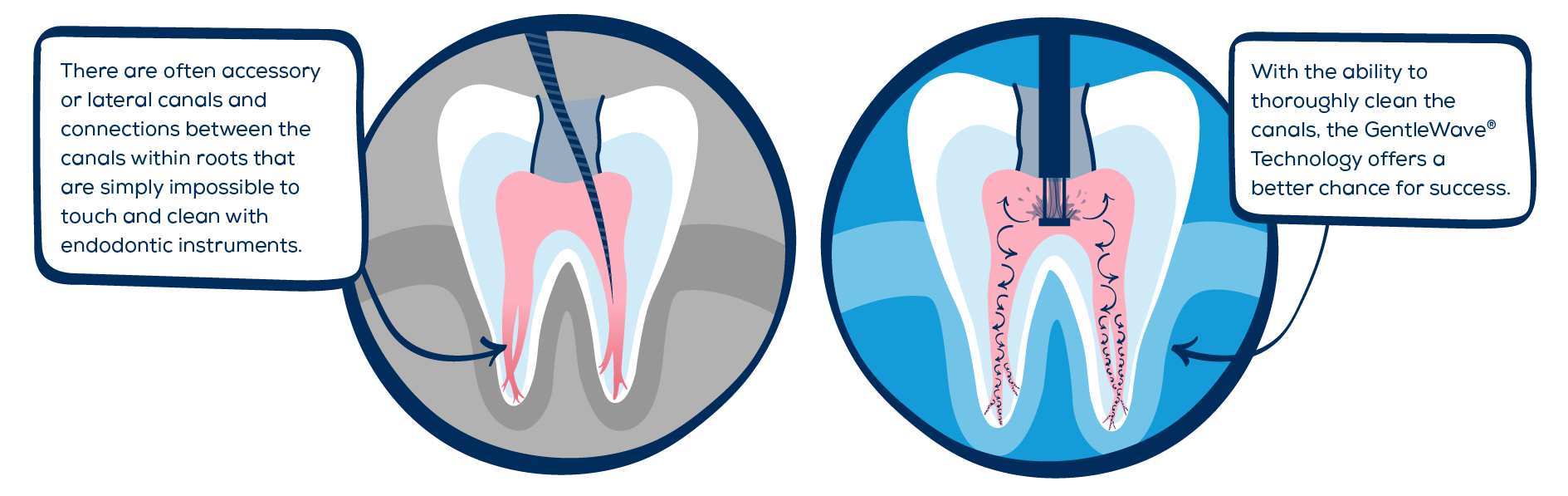 Understanding Your Root Canal Procedure Ask a Root Canal Specialist